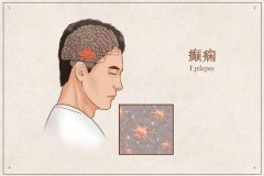 預防癲癇發作的護理措施